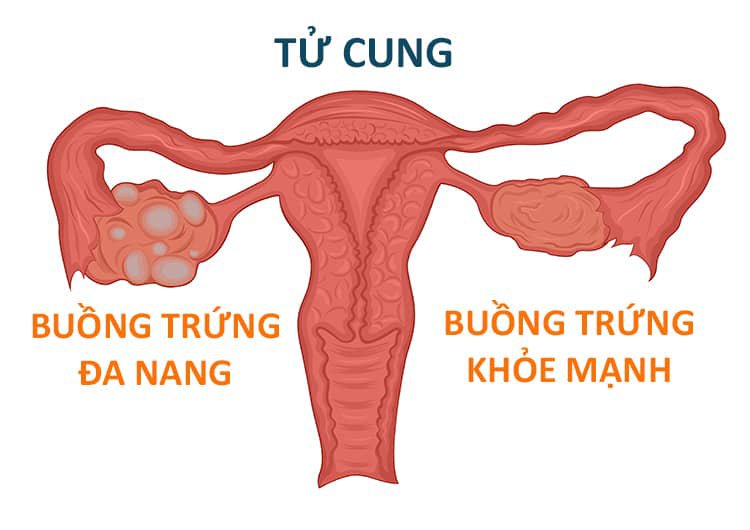 Nguyên nhân dẫn đến hội chứng buồng trứng đa nang ở nữ giới